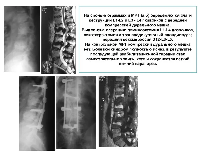 На спондилограммах и МРТ (а,б) определяются очаги деструкции L1-L2 и