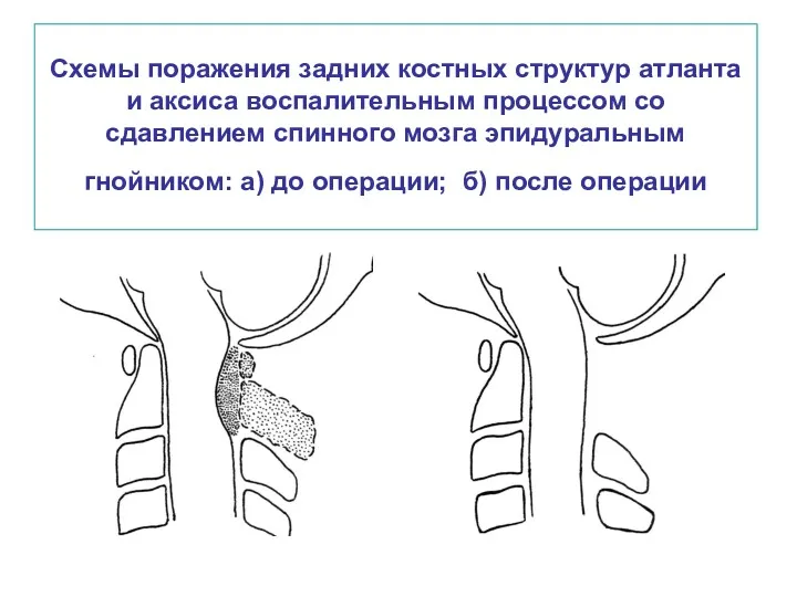 Схемы поражения задних костных структур атланта и аксиса воспалительным процессом