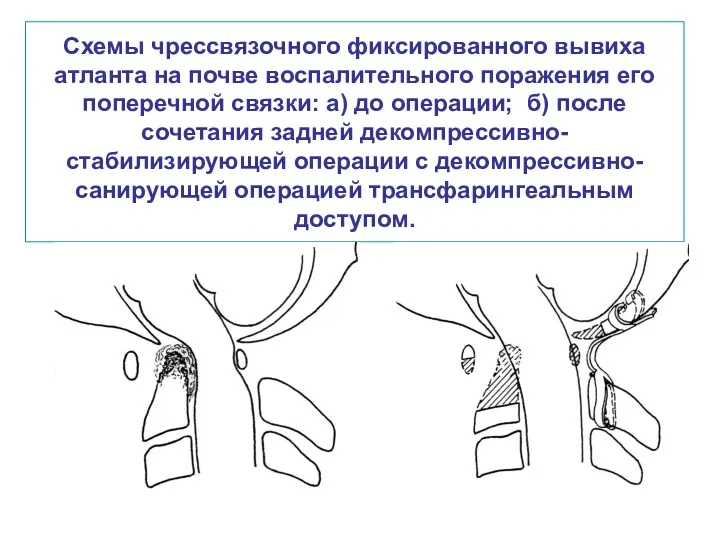 Схемы чрессвязочного фиксированного вывиха атланта на почве воспалительного поражения его