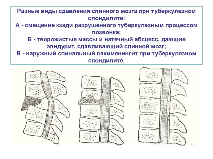 Разные виды сдавления спинного мозга при туберкулезном спондилите: А -