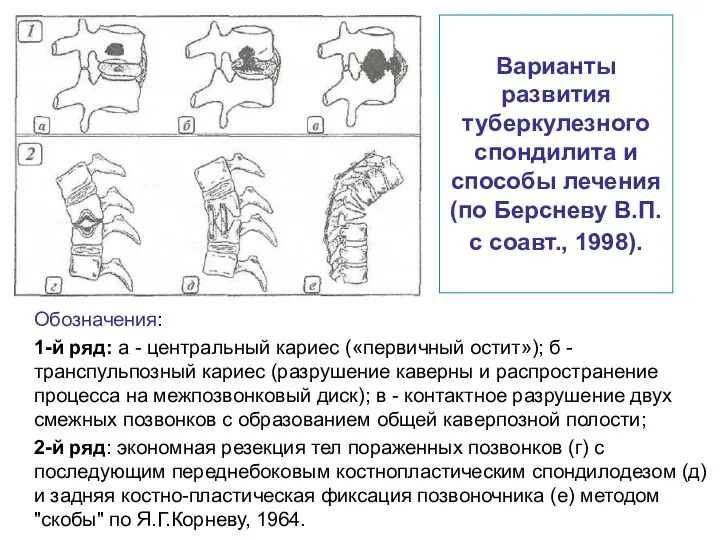 Варианты развития туберкулезного спондилита и способы лечения (по Берсневу В.П.