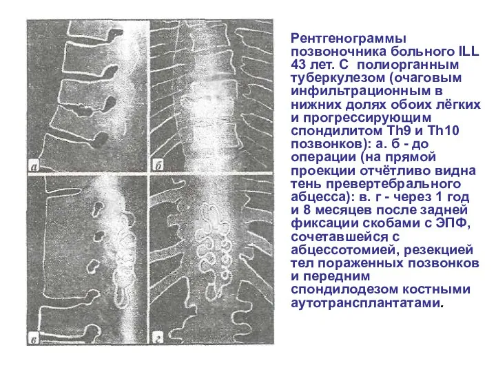 Рентгенограммы позвоночника больного ILL 43 лет. С полиорганным туберкулезом (очаговым