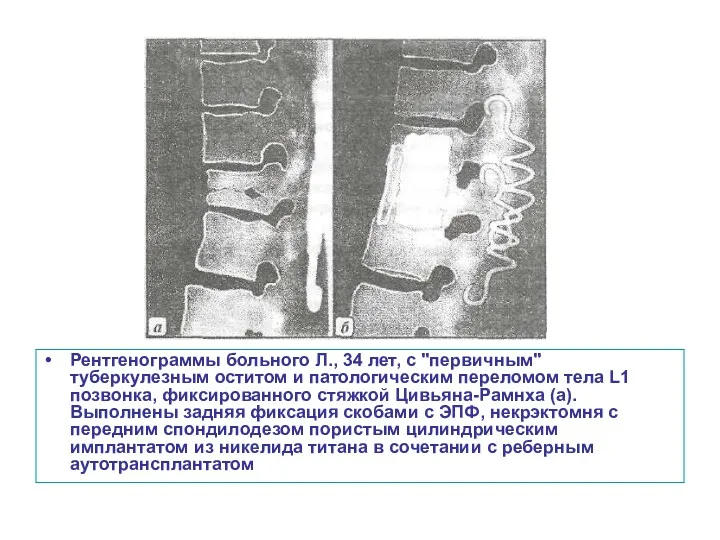 Рентгенограммы больного Л., 34 лет, с "первичным" туберкулезным оститом и