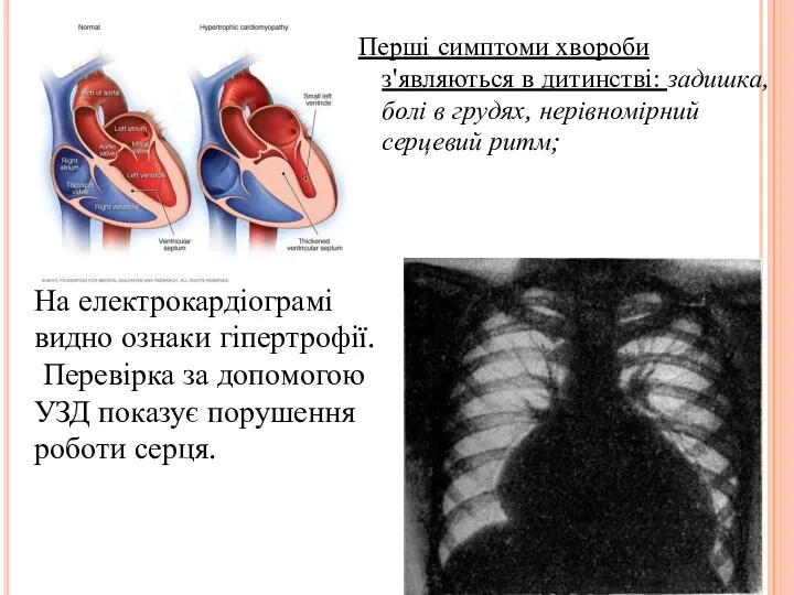 Перші симптоми хвороби з'являються в дитинстві: задишка, болі в грудях,