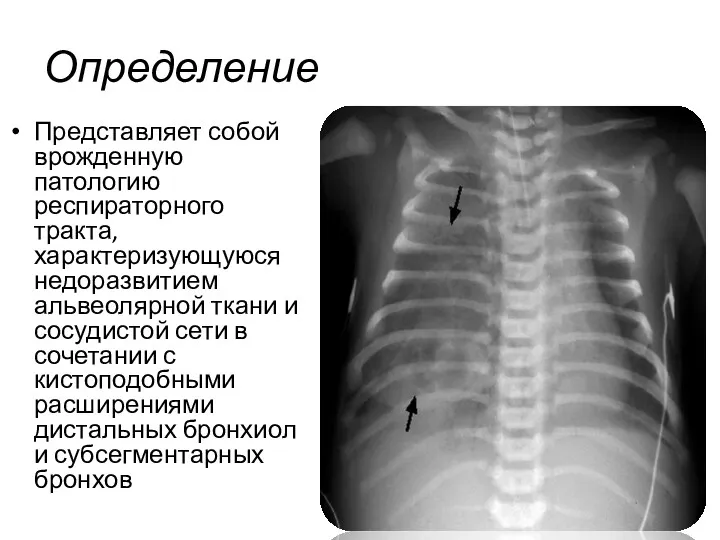 Определение Представляет собой врожденную патологию респираторного тракта, характеризующуюся недоразвитием альвеолярной