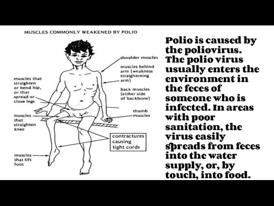 Polio is caused by the poliovirus. The polio virus usually enters the environment