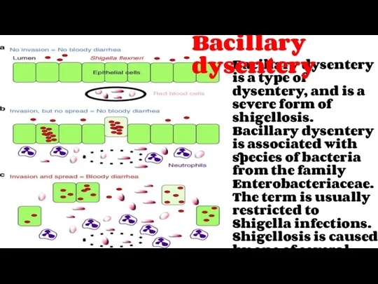 Bacillary dysentery is a type of dysentery, and is a severe form of