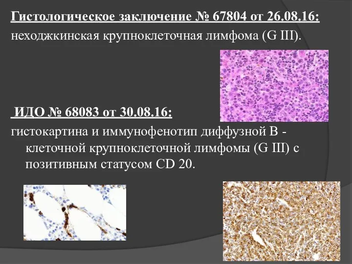 Гистологическое заключение № 67804 от 26.08.16: неходжкинская крупноклеточная лимфома (G III). ИДО №