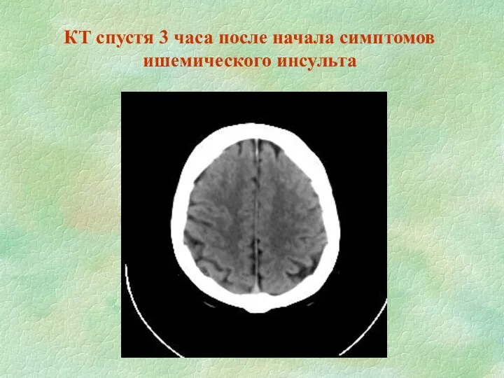 КТ спустя 3 часа после начала симптомов ишемического инсульта