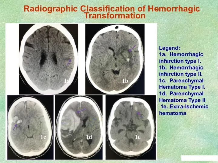 Radiographic Classification of Hemorrhagic Transformation Legend: 1a. Hemorrhagic infarction type
