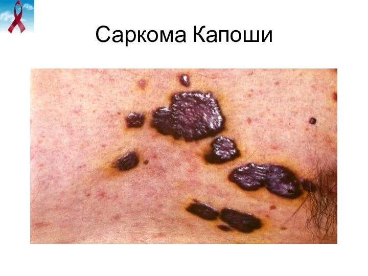 Саркома Капоши