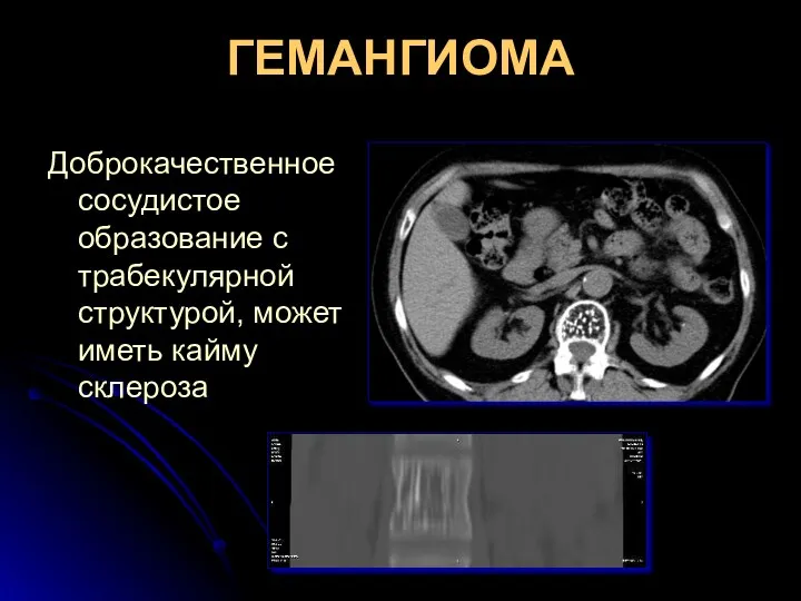 ГЕМАНГИОМА Доброкачественное сосудистое образование с трабекулярной структурой, может иметь кайму склероза