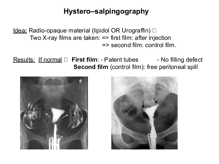 Hystero–salpingography Idea: Radio-opaque material (lipidol OR Urograffin) ? Two X-ray films are taken: