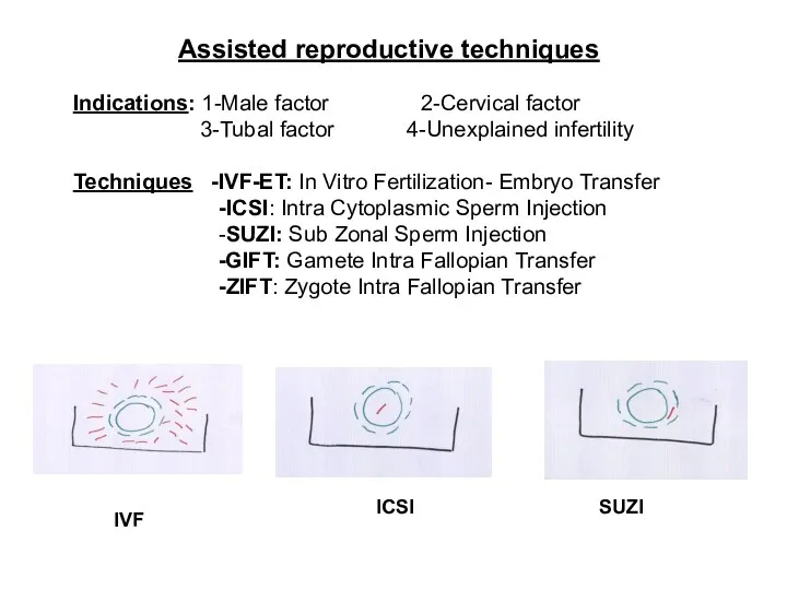Assisted reproductive techniques Indications: 1-Male factor 2-Cervical factor 3-Tubal factor 4-Unexplained infertility Techniques