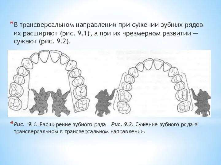 В трансверсальном направлении при сужении зубных рядов их расши­ряют (рис.