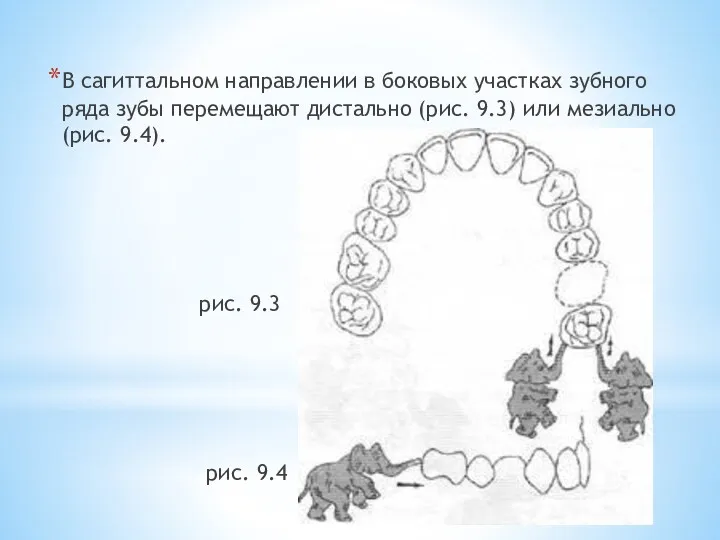 В сагиттальном направлении в бо­ковых участках зубного ряда зубы пе­ремещают