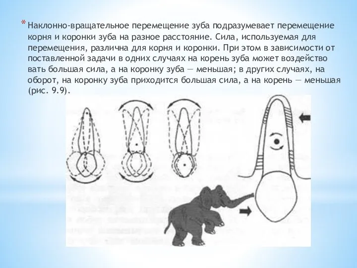 Наклонно-вращательное перемеще­ние зуба подразумевает перемещение корня и коронки зуба на