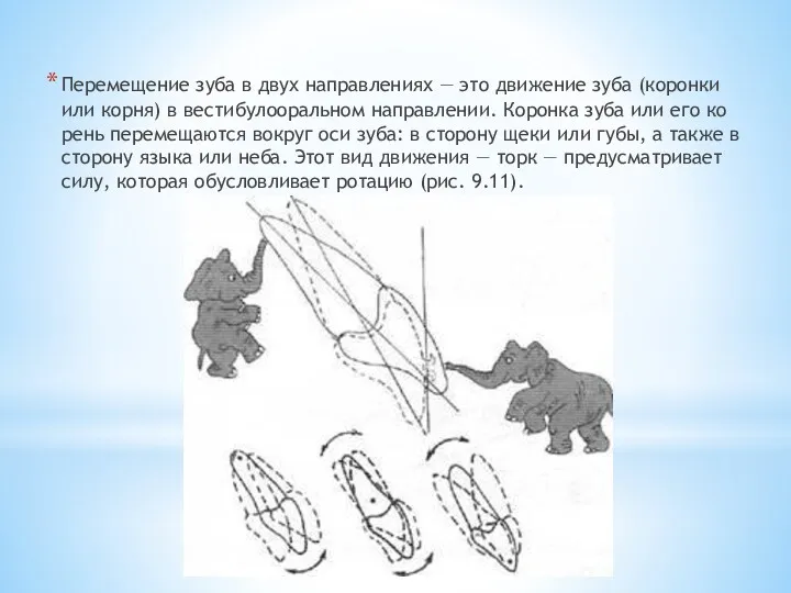 Перемещение зуба в двух направле­ниях — это движение зуба (коронки