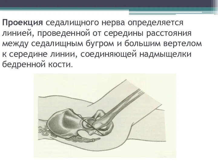 Проекция седалищного нерва определяется линией, проведенной от середины расстояния между