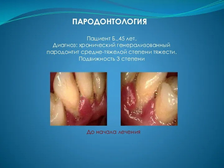 Пациент Б.,45 лет. Диагноз: хронический генерализованный пародонтит средне-тяжелой степени тяжести.