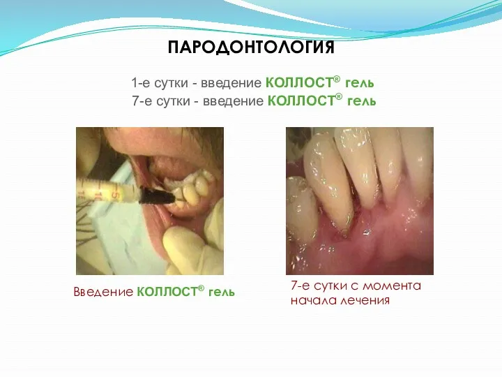 ПАРОДОНТОЛОГИЯ 1-е сутки - введение КОЛЛОСТ® гель 7-е сутки -