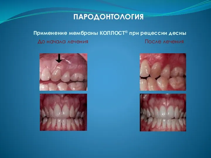 Применение мембраны КОЛЛОСТ® при рецессии десны ПАРОДОНТОЛОГИЯ До начала лечения После лечения