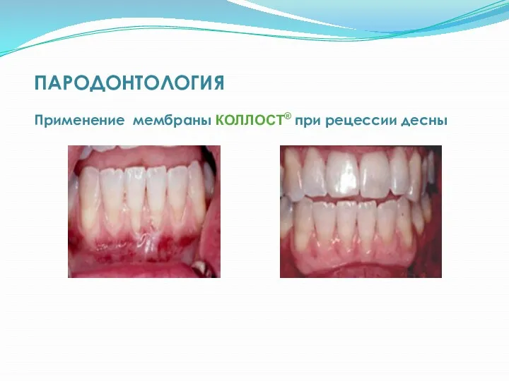 ПАРОДОНТОЛОГИЯ Применение мембраны КОЛЛОСТ® при рецессии десны