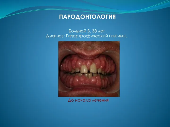 Больной В. 38 лет Диагноз: Гипертрофический гингивит. ПАРОДОНТОЛОГИЯ До начала лечения