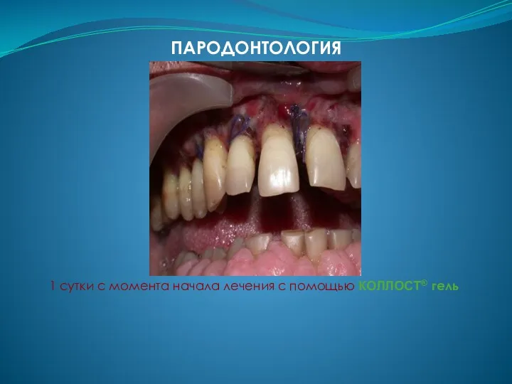 ПАРОДОНТОЛОГИЯ 1 сутки с момента начала лечения с помощью КОЛЛОСТ® гель