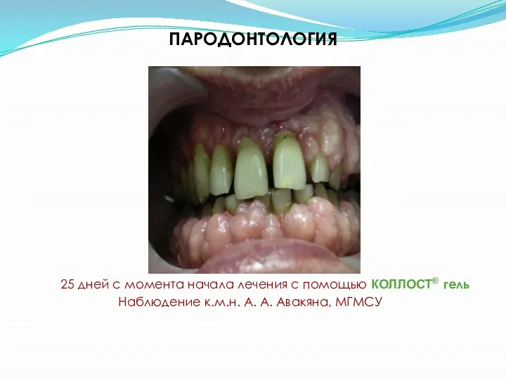 ПАРОДОНТОЛОГИЯ Наблюдение к.м.н. А. А. Авакяна, МГМСУ 25 дней с