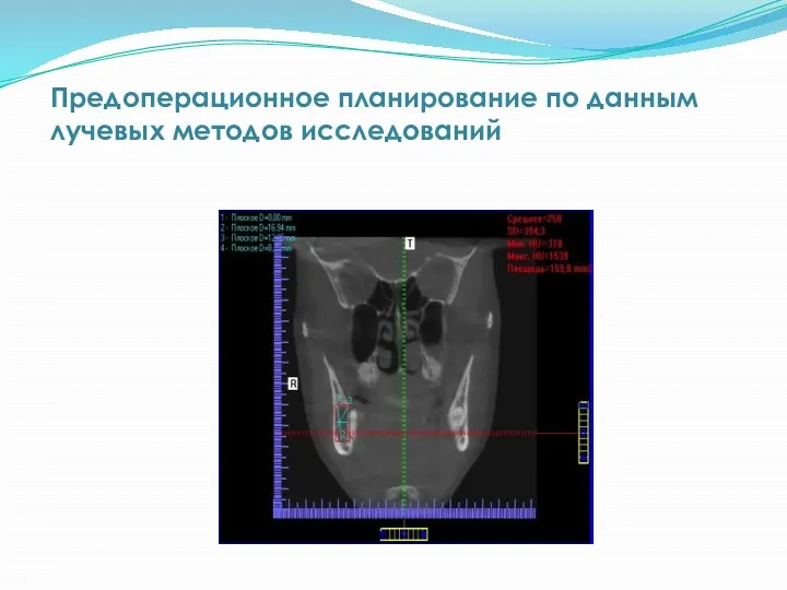 Предоперационное планирование по данным лучевых методов исследований