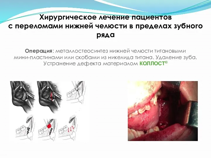 Хирургическое лечение пациентов с переломами нижней челюсти в пределах зубного