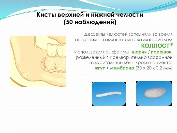 Кисты верхней и нижней челюсти (50 наблюдений) Дефекты челюстей заполняли