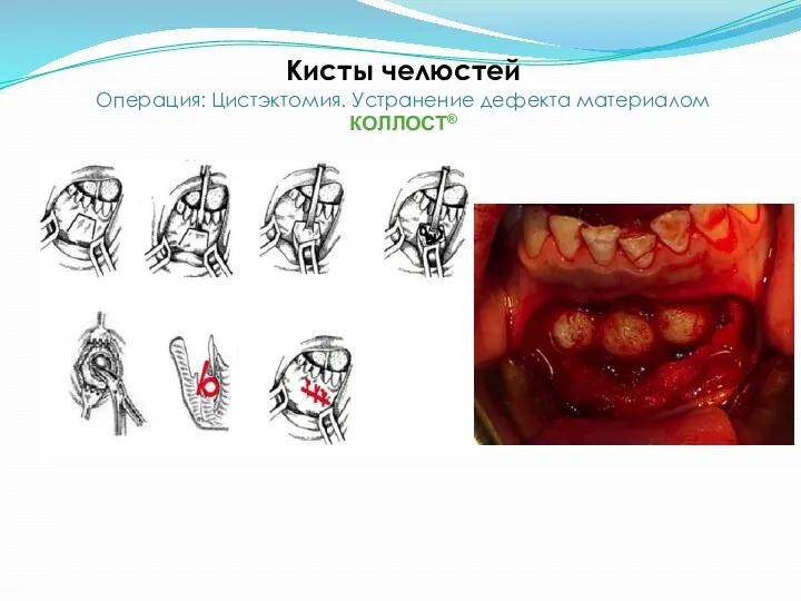 Кисты челюстей Операция: Цистэктомия. Устранение дефекта материалом КОЛЛОСТ®