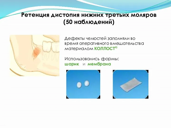 Ретенция дистопия нижних третьих моляров (50 наблюдений) Дефекты челюстей заполняли