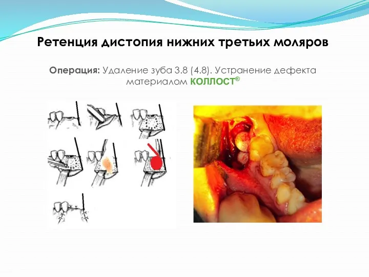 Ретенция дистопия нижних третьих моляров Операция: Удаление зуба 3.8 (4.8). Устранение дефекта материалом КОЛЛОСТ®