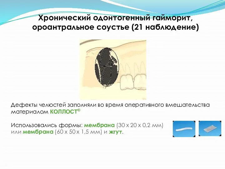 Хронический одонтогенный гайморит, ороантральное соустье (21 наблюдение) Дефекты челюстей заполняли