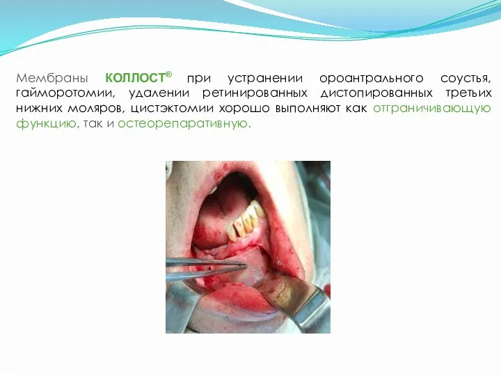 Мембраны КОЛЛОСТ® при устранении ороантрального соустья, гайморотомии, удалении ретинированных дистопированных