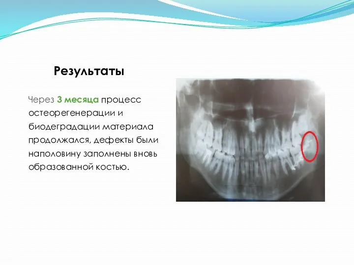 Результаты Через 3 месяца процесс остеорегенерации и биодеградации материала продолжался,