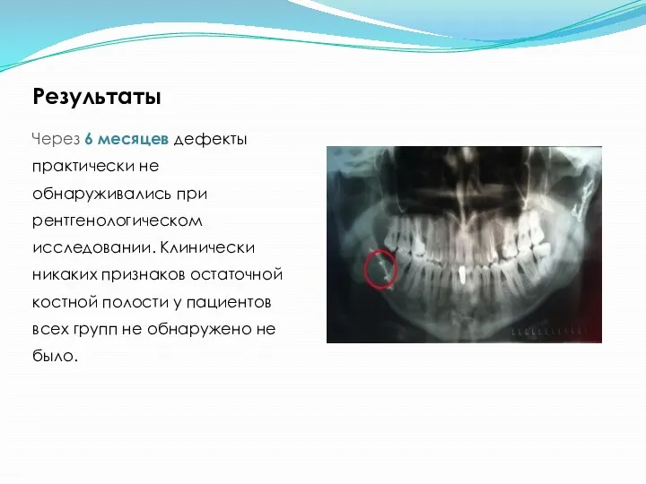 Результаты Через 6 месяцев дефекты практически не обнаруживались при рентгенологическом