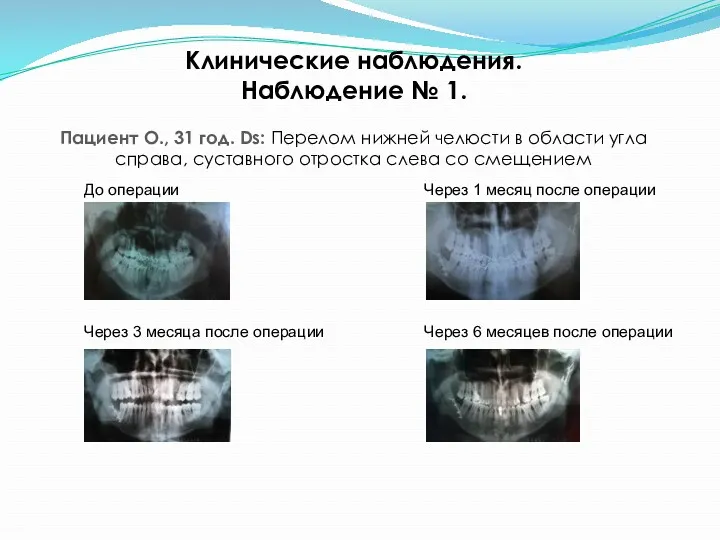 Клинические наблюдения. Наблюдение № 1. Пациент О., 31 год. Ds: