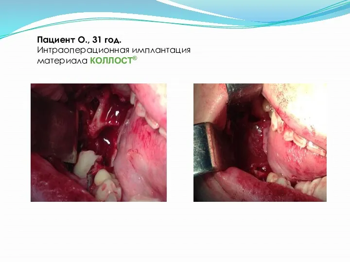 Пациент О., 31 год. Интраоперационная имплантация материала КОЛЛОСТ®