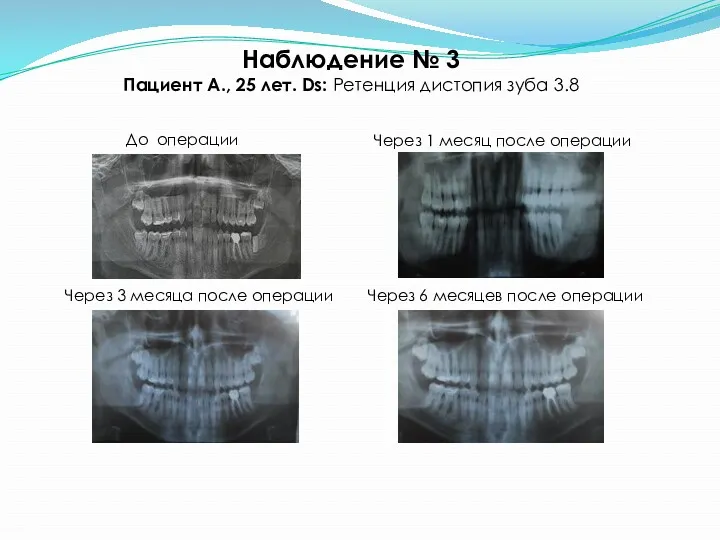 Наблюдение № 3 Пациент А., 25 лет. Ds: Ретенция дистопия