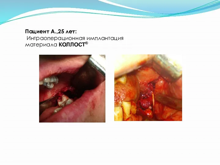 Пациент А.,25 лет: Интраоперационная имплантация материала КОЛЛОСТ®