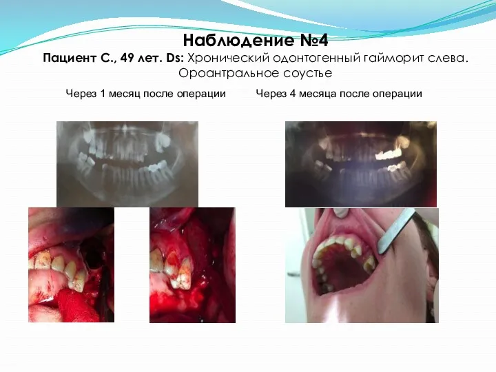 Наблюдение №4 Пациент С., 49 лет. Ds: Хронический одонтогенный гайморит