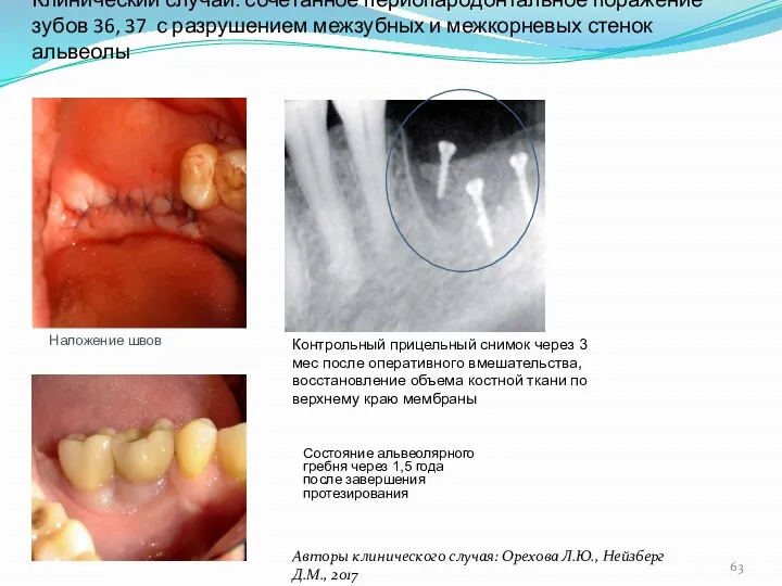 Клинический случай: сочетанное периопародонтальное поражение зубов 36, 37 с разрушением