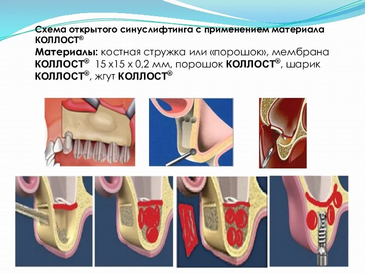 Схема открытого синуслифтинга с применением материала КОЛЛОСТ® Материалы: костная стружка