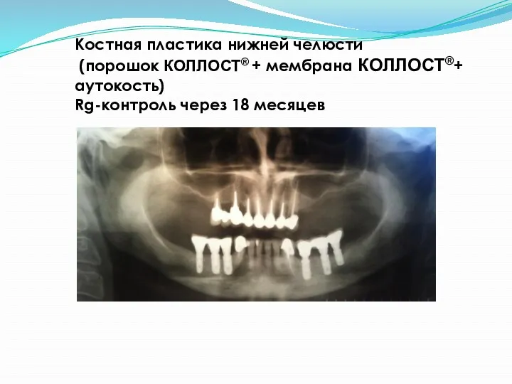 Костная пластика нижней челюсти (порошок КОЛЛОСТ® + мембрана КОЛЛОСТ®+ аутокость) Rg-контроль через 18 месяцев