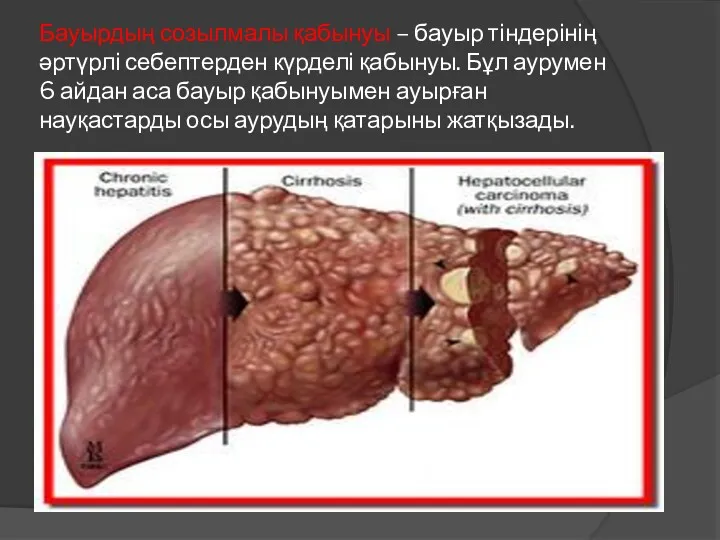 Бауырдың созылмалы қабынуы – бауыр тіндерінің әртүрлі себептерден күрделі қабынуы.