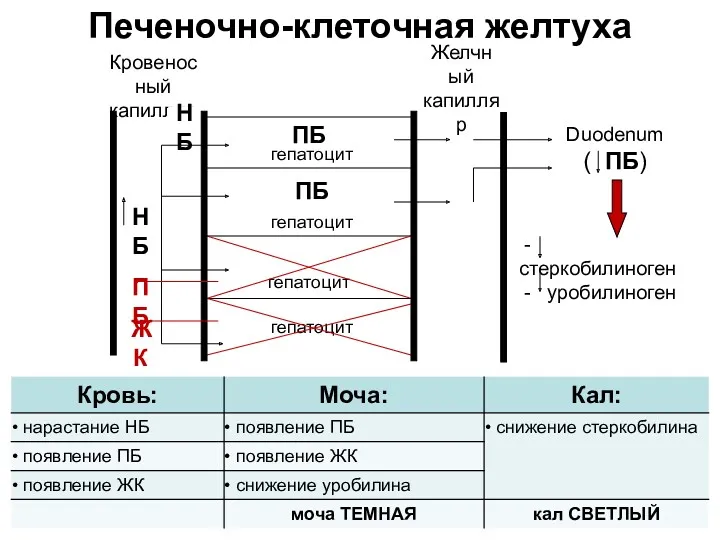 Печеночно-клеточная желтуха Duodenum ( ПБ) - стеркобилиноген - уробилиноген гепатоцит